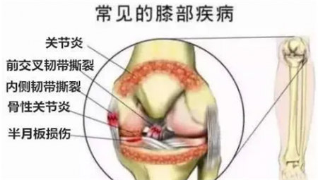 东方红航天生物——认识膝盖结果，预防膝盖损伤