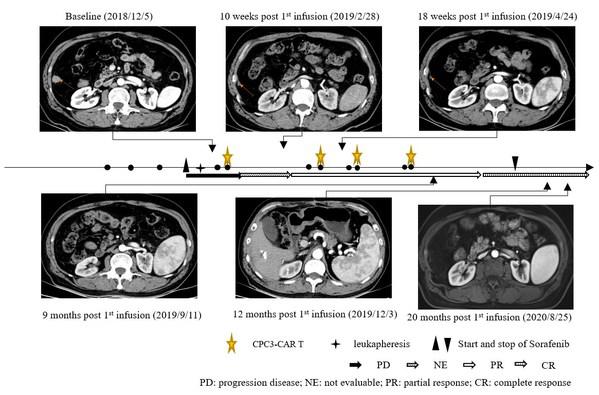 科济药业CT011治疗晚期肝细胞癌的长期生存案例报告在《Frontiers in Immunology》杂志发表