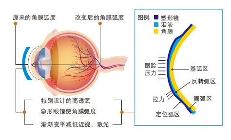 普瑞眼科专家解答：到底什么是角膜塑形镜？